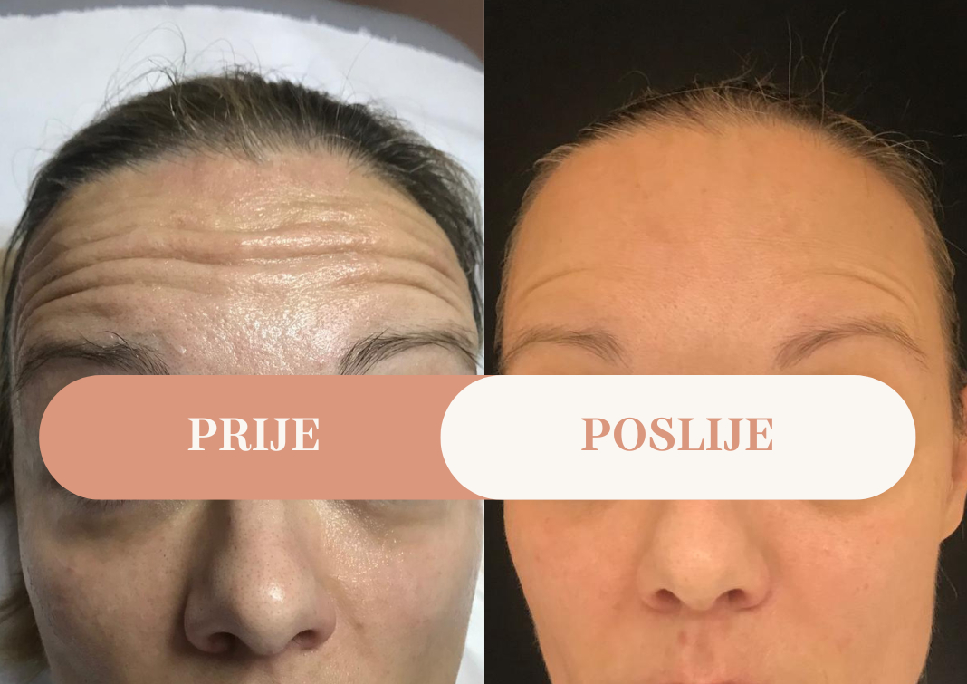 Prije i poslije — botulinum toksin